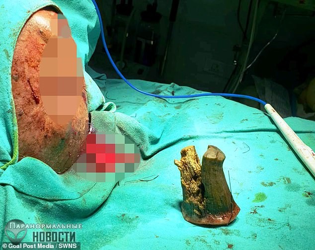 На лбу пожилого индийца вырос «дьявольский» рог