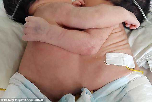 В Гондурасе сиамских близнецов с одним сердцем на двоих решили не разделять из